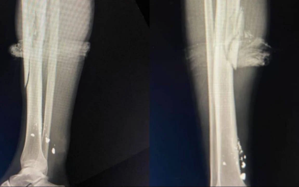 Joven de 17 años herido en La Plata: ataque de motochorros durante paseo con su novia